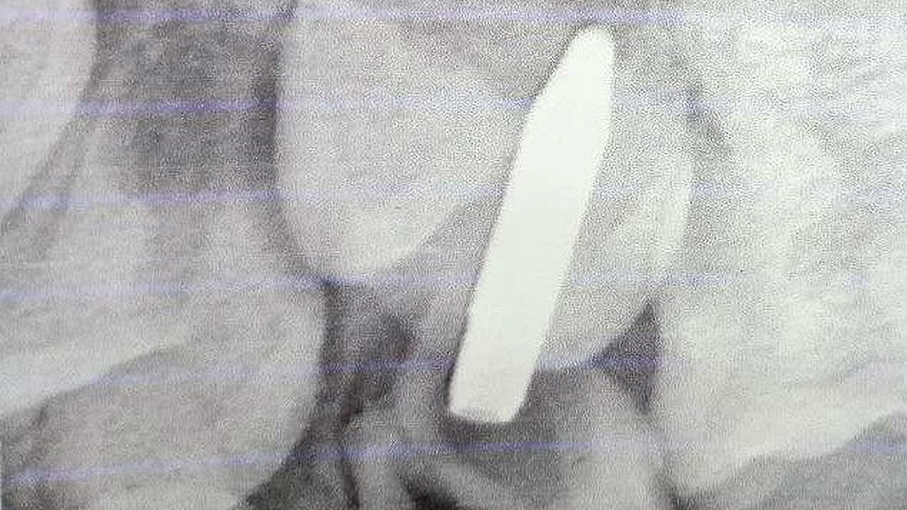 Главная картинка новости: Стоматологи помогли мальчику, который случайно воткнул стержень ручки в зуб